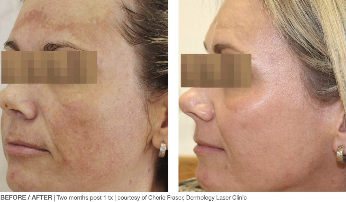 laser skin rejuvenation before after